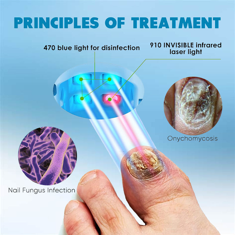 🔥(Official Mall)💖QIAWI™ Revolutionary High-Efficiency Light Therapy Device For Toenail Diseases-🗽Made and Shipped from USA 🔥 - YN