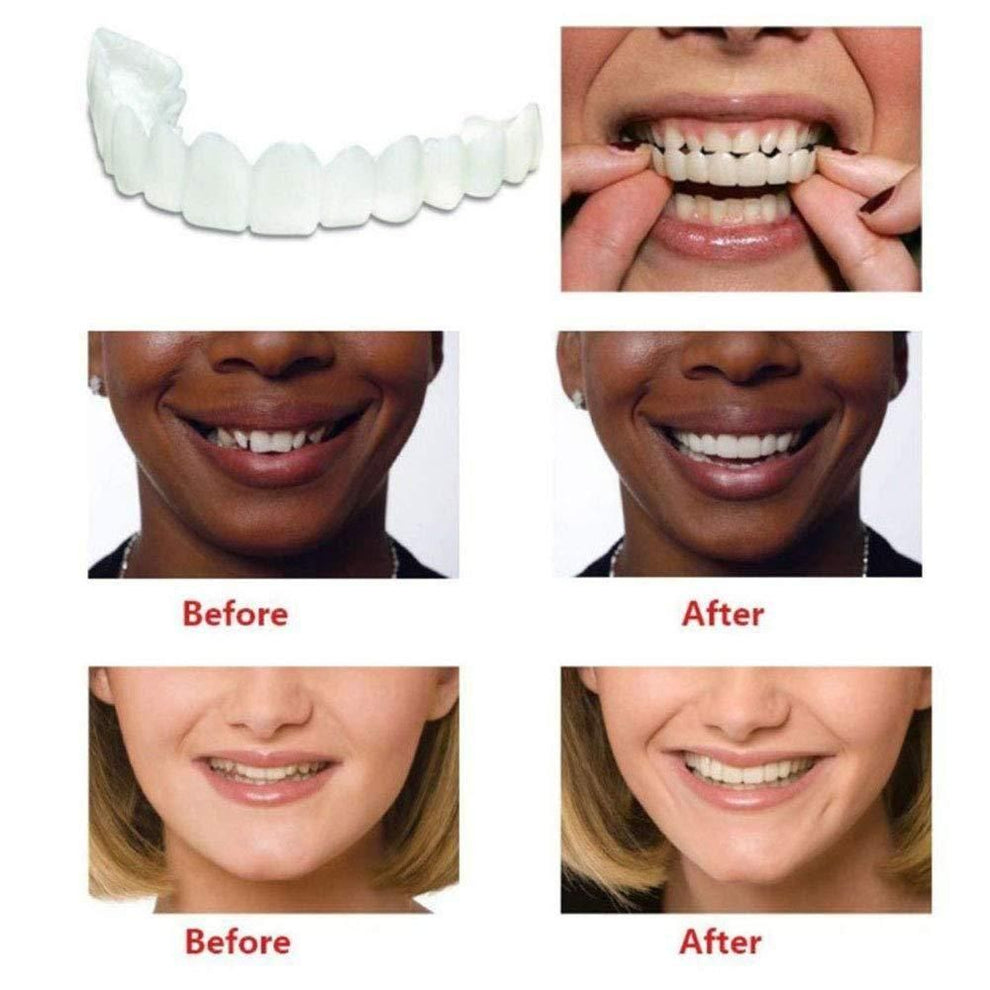 Snap-On Smile – Get Your Perfect Smile Instantly! - YN