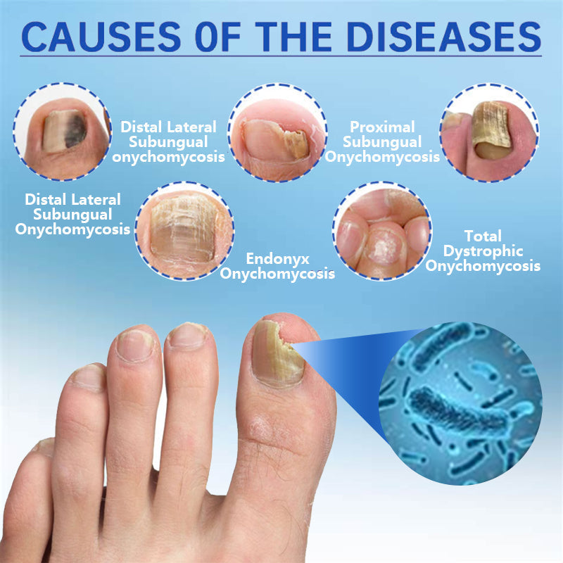 🔥(Official Mall)💖QIAWI™ Revolutionary High-Efficiency Light Therapy Device For Toenail Diseases-🗽Made and Shipped from USA 🔥 - YN