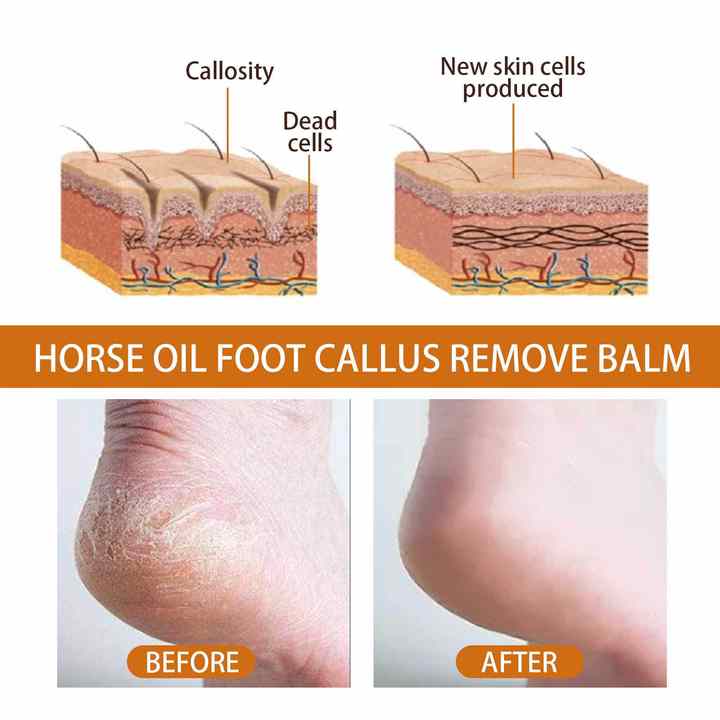 Horse Oil Foot Callus Remedy Balm - YN